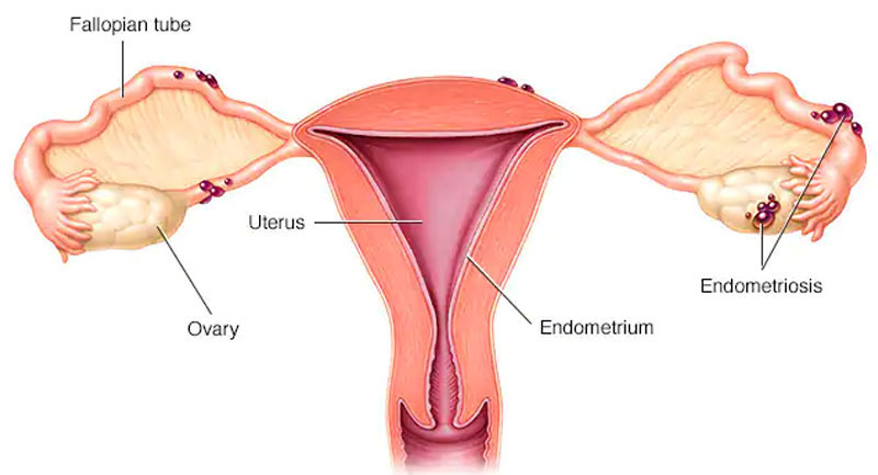 Help with discomfort – Compelling Endometriosis Torment Treatment Choices